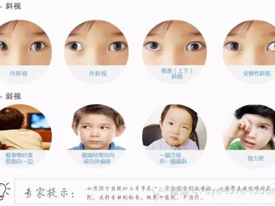 孩子斜弱視治療,不要錯(cuò)過(guò)關(guān)鍵時(shí)機(jī)