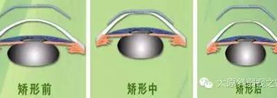 孩子度數持續增長怎么辦？