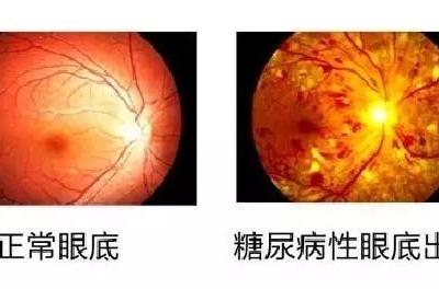 糖尿病會導致眼睛失明，視力模糊是前期征兆！