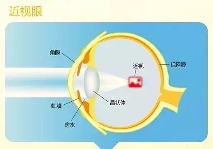 近視的原因、預(yù)防與治療 近視的原因、預(yù)防與治療