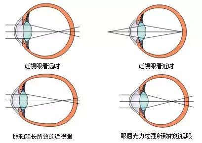 適齡兒童不論視力好壞都應該驗光 適齡兒童不論視力好壞都應該驗光