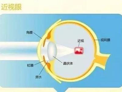 近視的原因、預防與治療