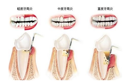 為什么會有牙周病?牙周病的中醫治療和保養方法-易網<a href=http://www.jsjjzhkt.cn/ target=_blank class=infotextkey>健康養生</a>網 為什么會有牙周病?牙周病的中醫治療和保養方法
