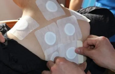 三伏貼必須入伏當天貼嗎