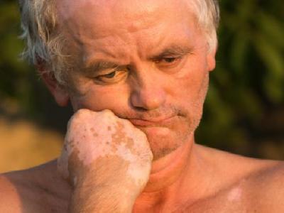 中醫針灸會不會疼? 這4種人不適合做針灸