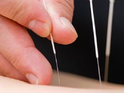 中醫(yī)治鼻咽癌的針灸療法有哪些 中醫(yī)針灸治鼻咽癌的四個(gè)療法