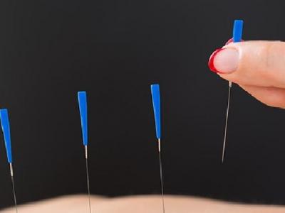 中醫針灸治療痛經效果好嗎 中醫針灸治療痛經需了解三方面