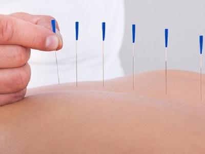 中醫(yī)針灸是怎么治療痤瘡的 中醫(yī)應對痤瘡的針灸治療法介紹