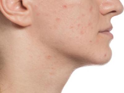 面癱要怎樣治療效果好恢復(fù)快 中醫(yī)教你自我按摩輕松治療面癱