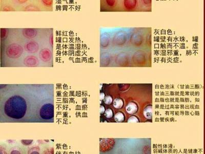 拔罐顏色癥狀對照表圖解,深淺代表不同病癥(越淺越好)