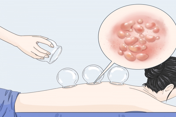 拔罐多久可以吹空調