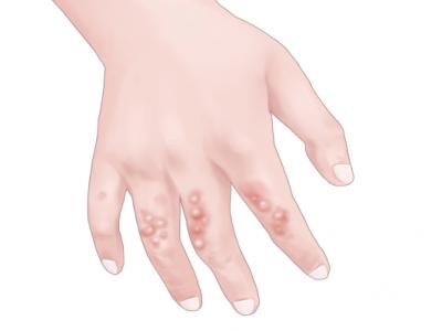 濕疹用忍冬藤泡澡管用嗎?